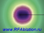 www.RFAblation.ru